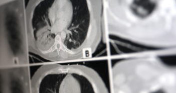 KI untersucht blitzschnell CT-Aufnahmen; Rechte: WDR/Schieb